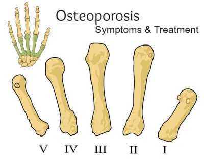 Signs, symptoms of osteoporosis.